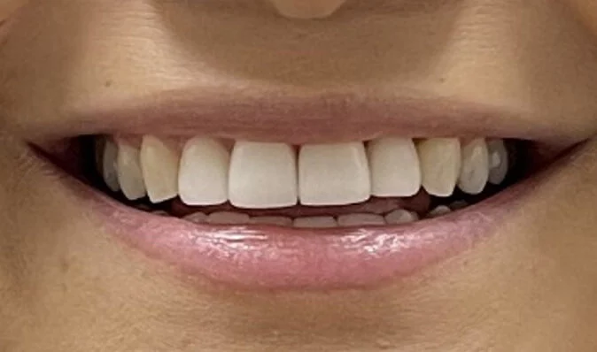 after photo of a patient's teeth