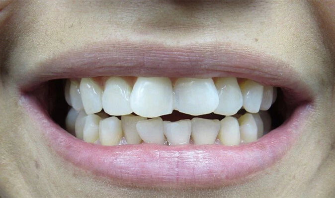 before photo of a patient's teeth